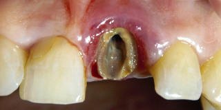 Имплантация зубов: до (рис. 1)