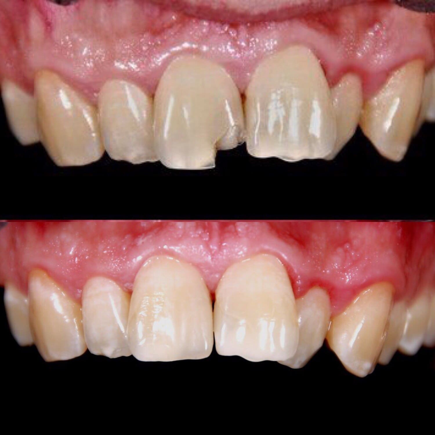 Реставрация зубов: до и после (рис. 1)