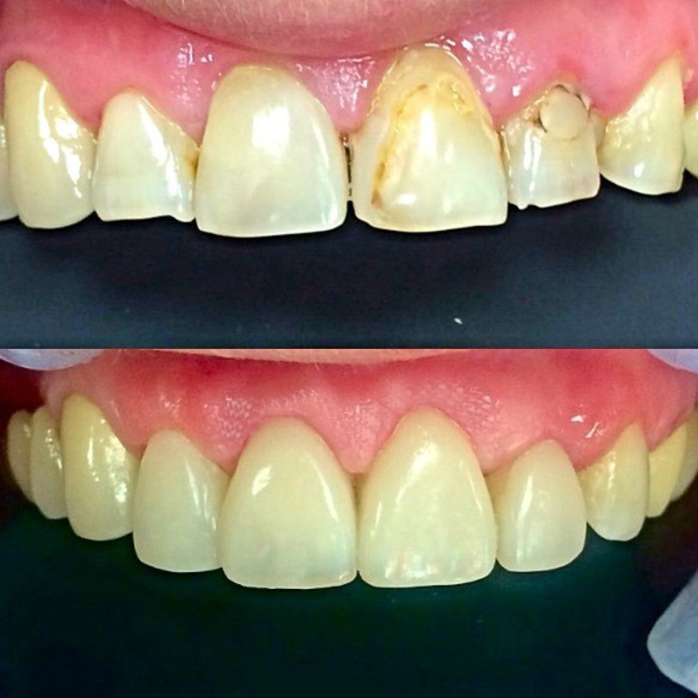 Реставрация зубов: до и после (рис. 2)