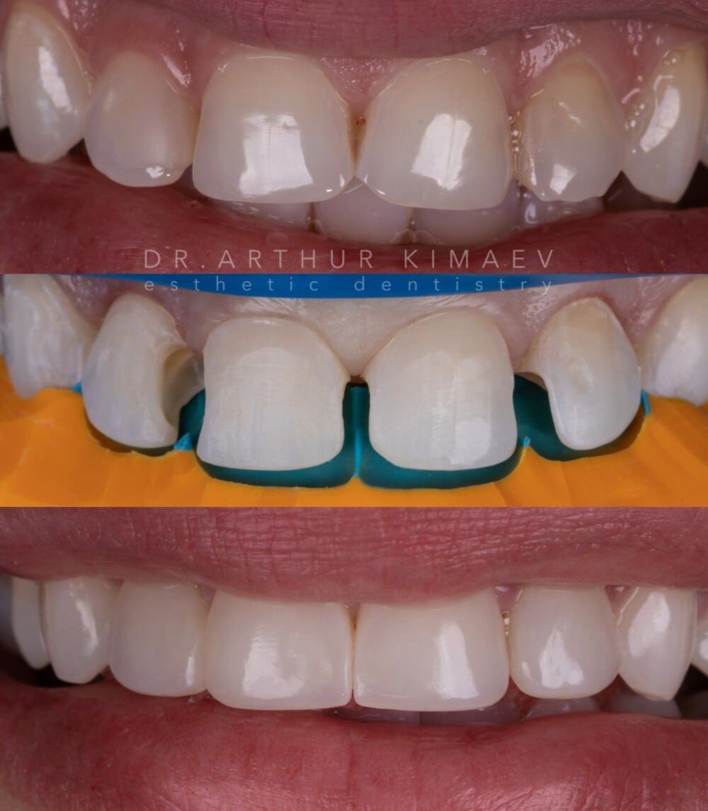 Реставрация зубов до/после