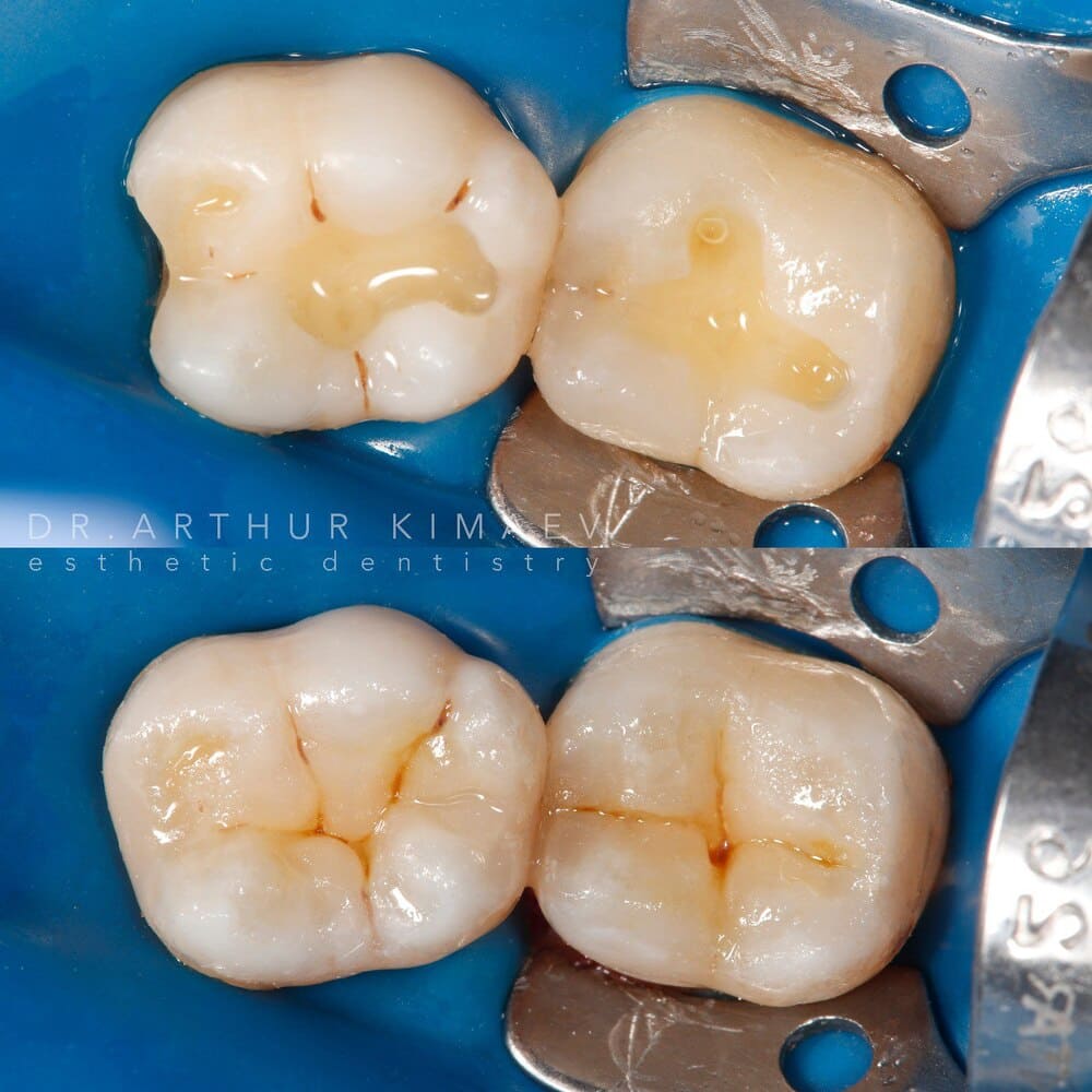 Лечение зубов до/после
