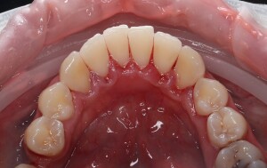 Чистка зубов: фото после (рис. 2)