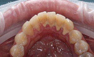 Чистка зубов: фото до (рис. 1)