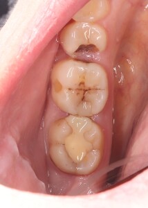 Реставрация зубов: фото до (рис. 1)