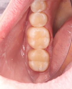 Реставрация зубов: фото после (рис. 2)