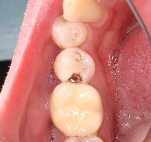 Лечение кариеса зубов: фото до (рис. 1)