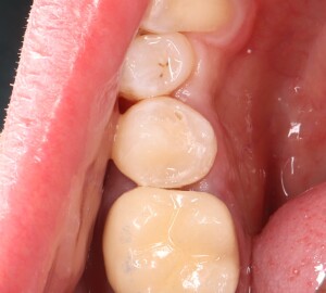 Лечение кариеса зубов: фото после (рис. 2)