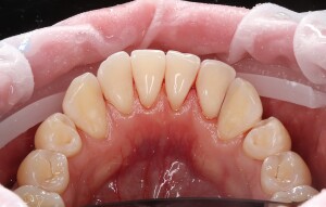 Отбеливание зубов: фото после (рис. 2)