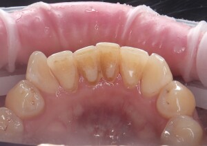 Отбеливание зубов: фото до (рис. 1)