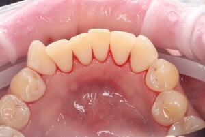 Чистка зубов: фото после (рис. 2)