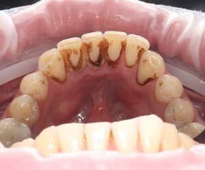 Чистка зубов: фото до (рис. 1)