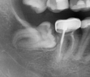 Зуб мудрости: рентгеновский снимок (рис. 1)