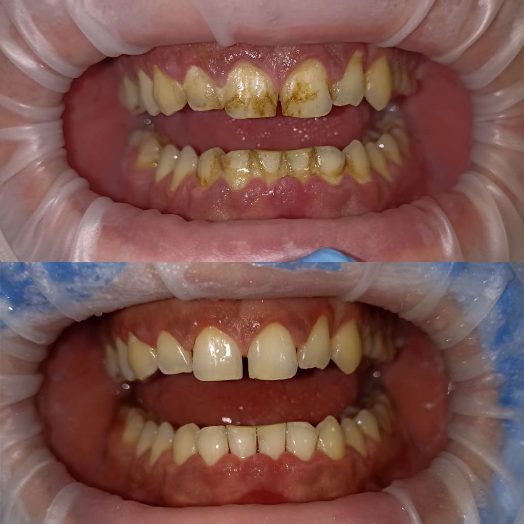 Профессиональная гигиена зубов до/после